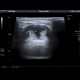 Median cervical cyst: US - Ultrasound